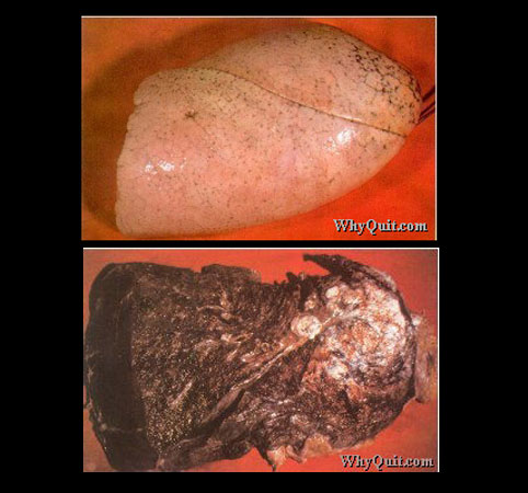 Entre las múltiples enfermedades que provoca el consumo de tabaco, está el cáncer de pulmón  agresiva y letal.  En la parte superior de la imagen, un pulmón sano, en la parte inferior, el pulmón de un fumador enfermo de cáncer. 