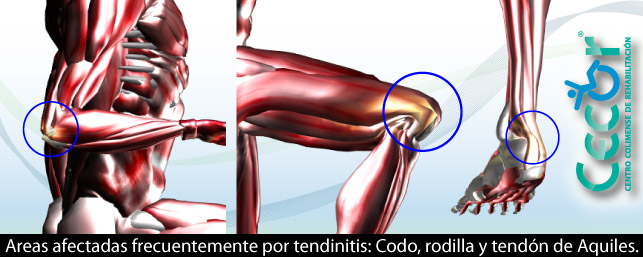 post_tendinitis